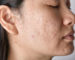 ACNE SCAR TREATMENT IN WINNIPEG
