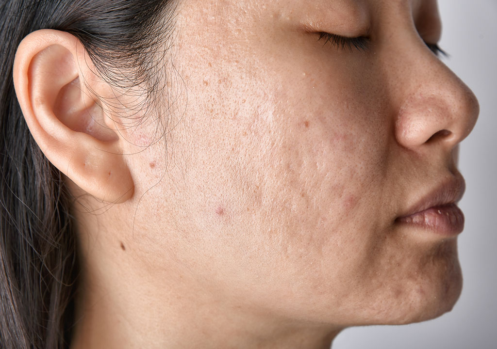 ACNE SCAR TREATMENT IN WINNIPEG
