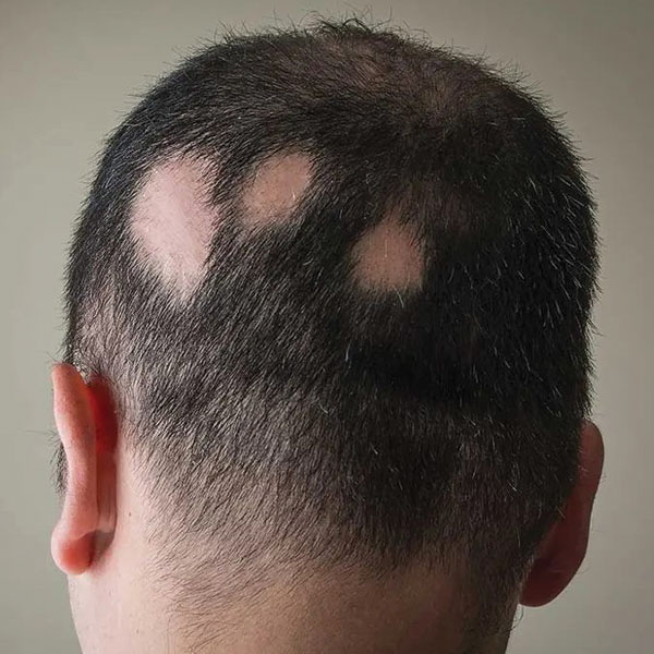 alopecia alopecia