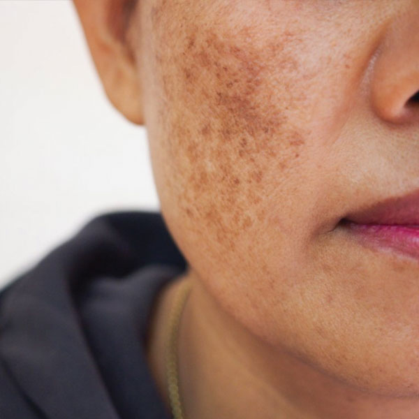 melasma melasma
