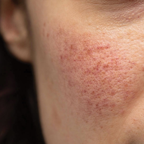 rosacea rosacea