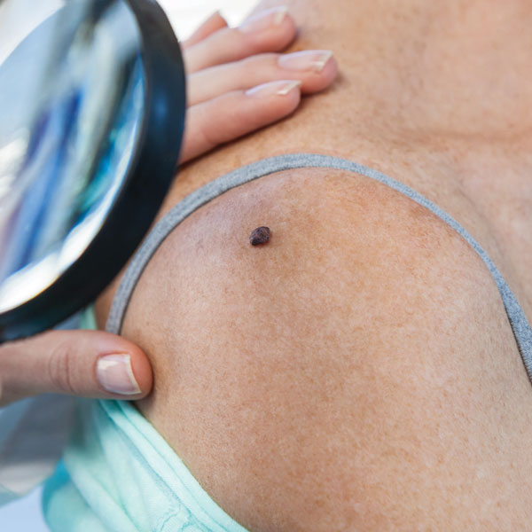 skin-lesion mole